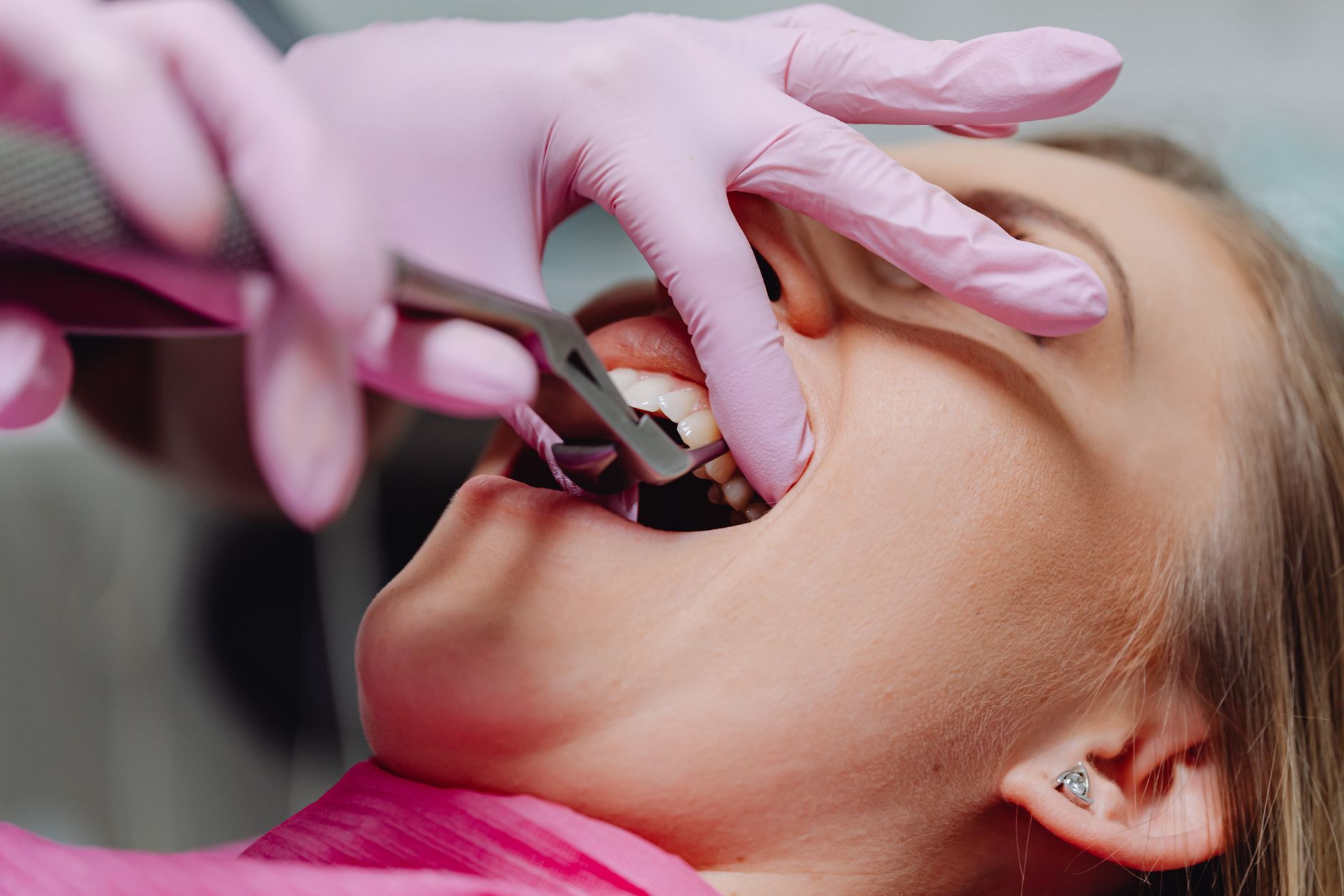 Pacjent podczas zabiegu stomatologicznego, dentysta w różowych rękawiczkach