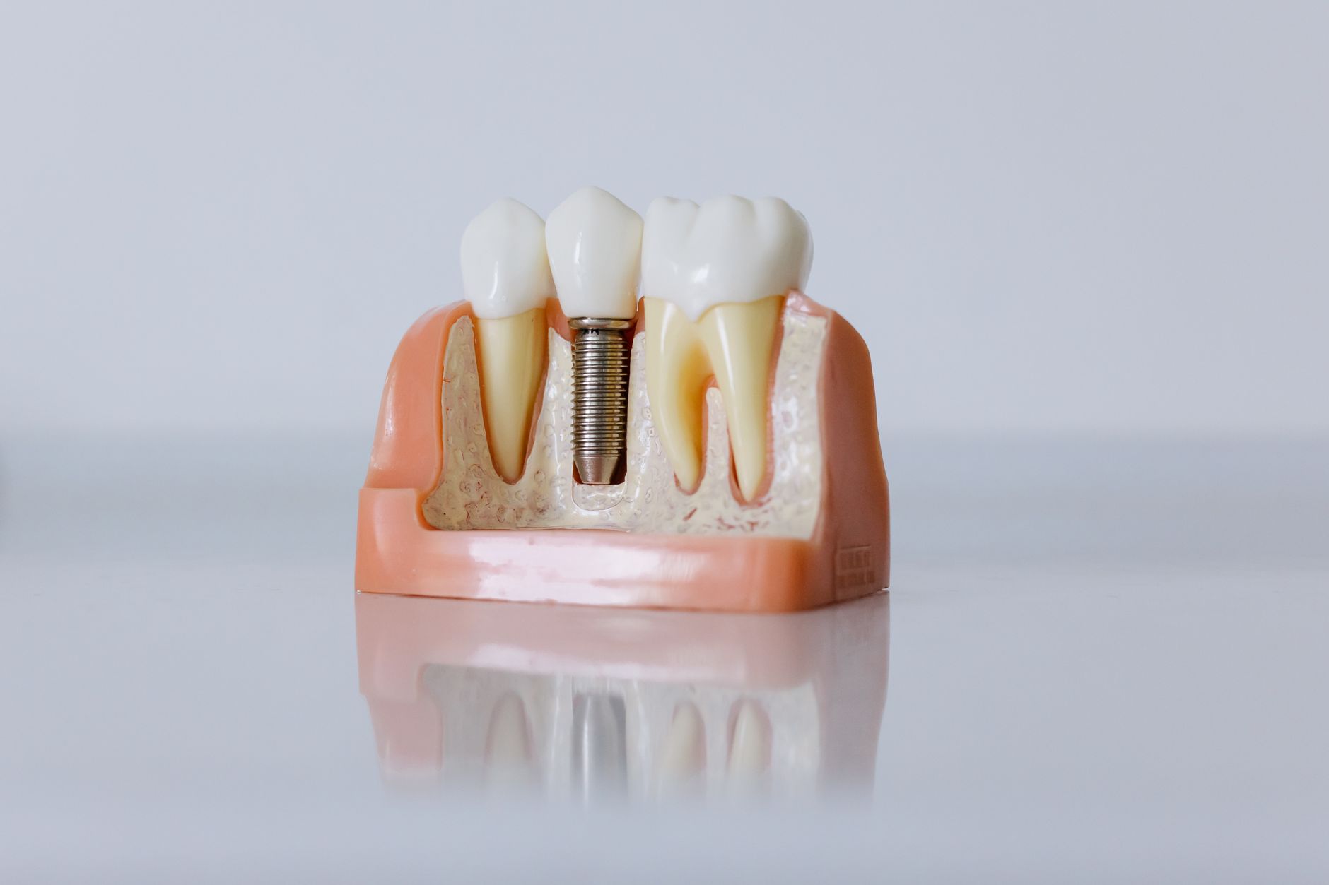 Model implantu zębowego z widoczną strukturą zęba
